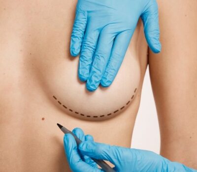 woman-marked-out-cosmetic-surgery_273609-14510