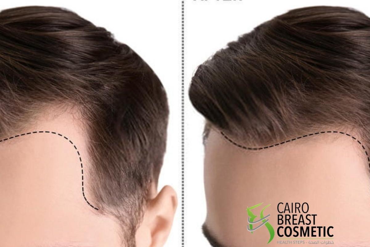 اسعار زراعة الشعر في مصر