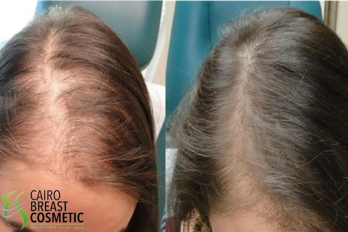 توقعات ما بعد إجراء عملية زراعة الشعر