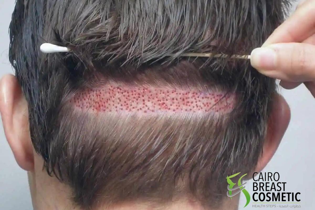 شروط نجاح عملية زراعة الشعر