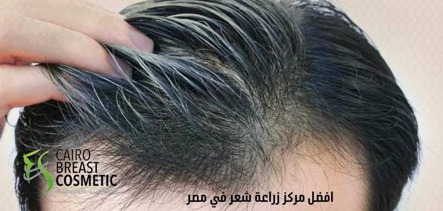 افضل مركز زراعة شعر في مصر