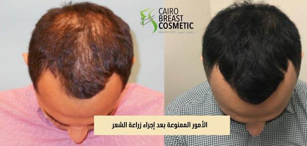 الأمور الممنوعة بعد إجراء زراعة الشعر