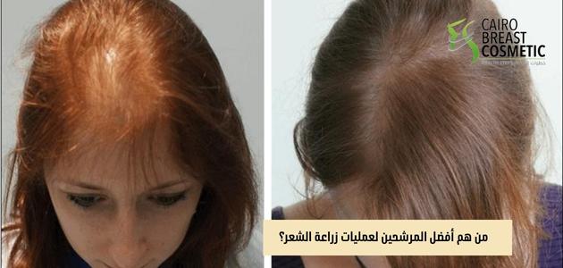 من هم أفضل المرشحين لعمليات زراعة الشعر؟